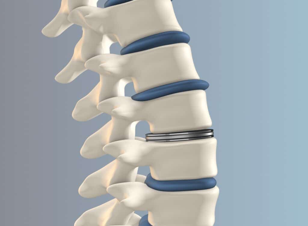 NASS Spine Image Metal spine implant